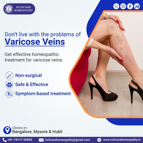 varicose veins homepathy treatment