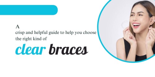 A-crisp-and-helpful-guide-to-help-you-choose-the-right-kind-of-clear-braces.jpg