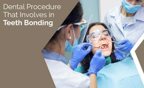 Dental-procedure-that-involves-in-teeth-bonding.jpg