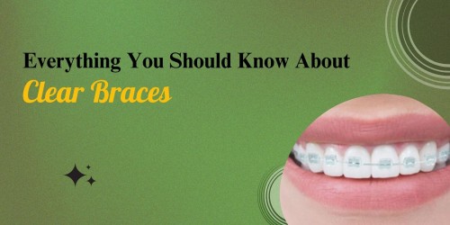 Everything-You-Should-Know-About-Clear-Braces.jpg