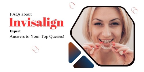 FAQs-about-Invisalign-Expert-Answers-to-Your-Top-Queries.jpg