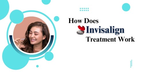 How-Does-Invisalign-Treatment-Work.jpg