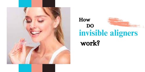 How-do-invisible-aligners-work.jpg