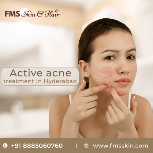 Active-Acne.png