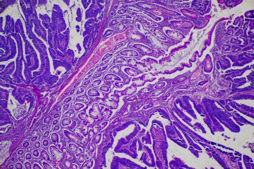 Common-Types-of-Bone-Tumors.jpg