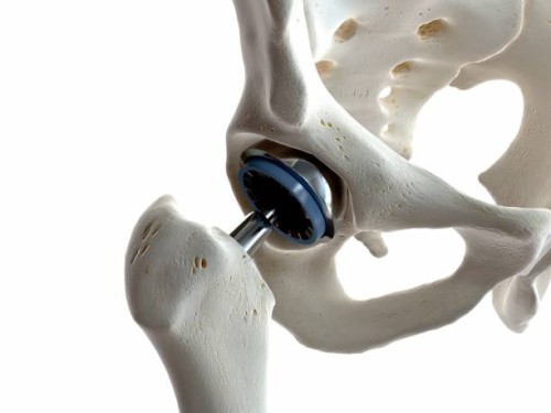Hip-Replacement.jpg