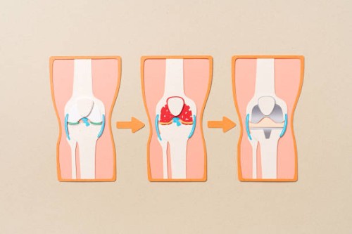 Osteotomy-vs.-Joint-Replacement-Which-is-Better.jpg