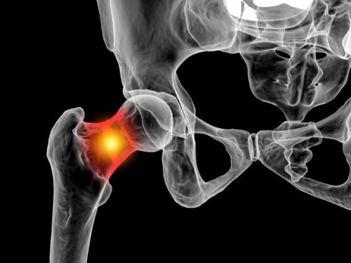 Periacetabular-Osteotomy-2.jpg