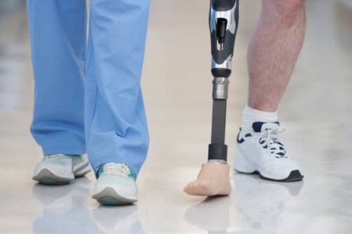 The-Psychological-Impact-of-Amputation.jpg