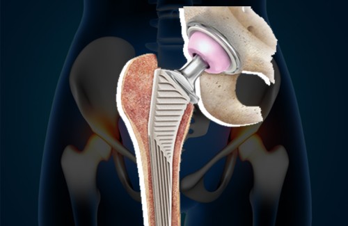 Hip-Replacement-Surgery-Cost-in-India.jpg