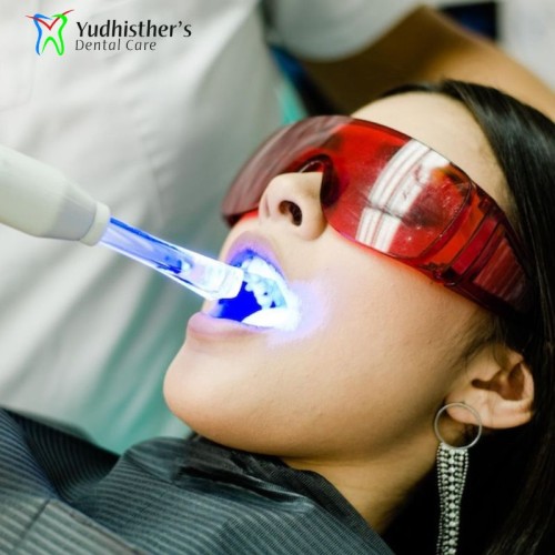 Best-Teeth-WhiteningBleaching-in-paschim-vihar.jpg