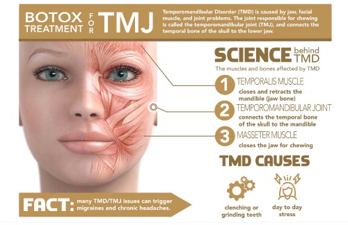 Botox-for-TMJ2.jpg